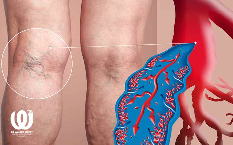 علاج الدوالى بتقنية الكلاكس